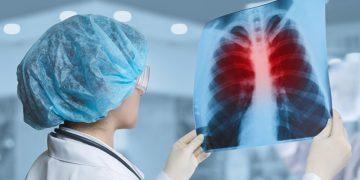 WHO: Bệnh lao trở lại là nguyên nhân gây tử vong hàng đầu do bệnh truyền nhiễm